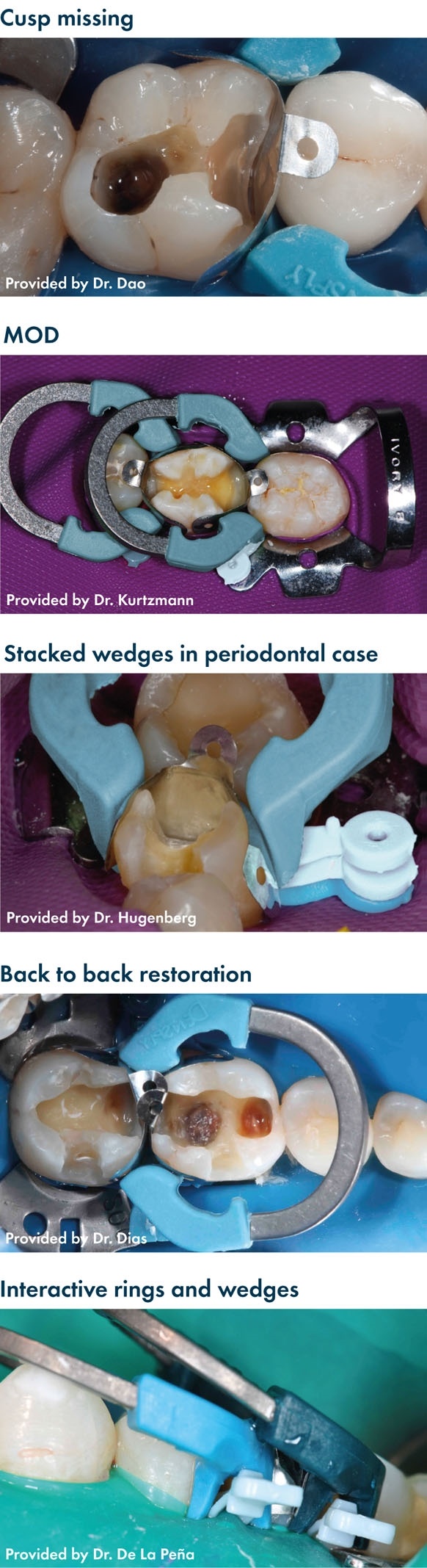 Palodent V3